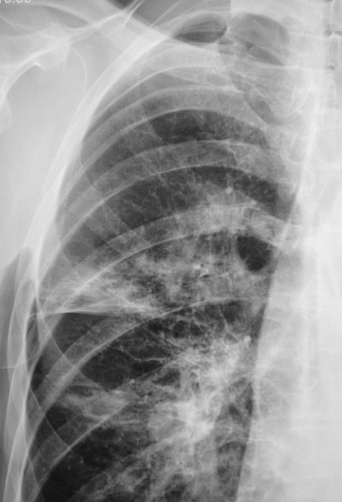 Пневмонии на рентгене у взрослых фото