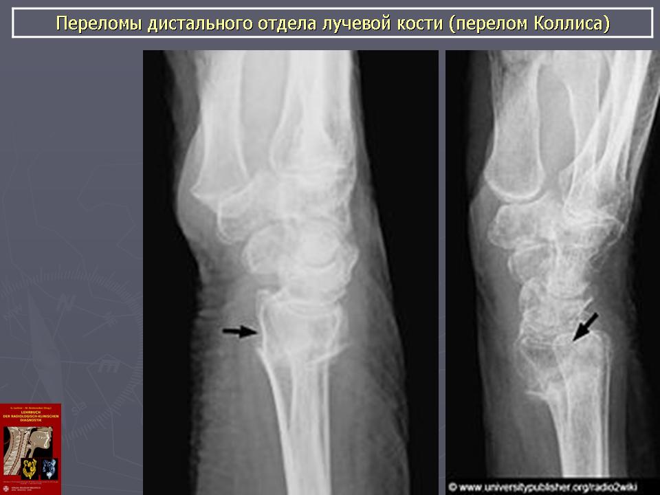 Перелом дистального метаэпифиза лучевой кости