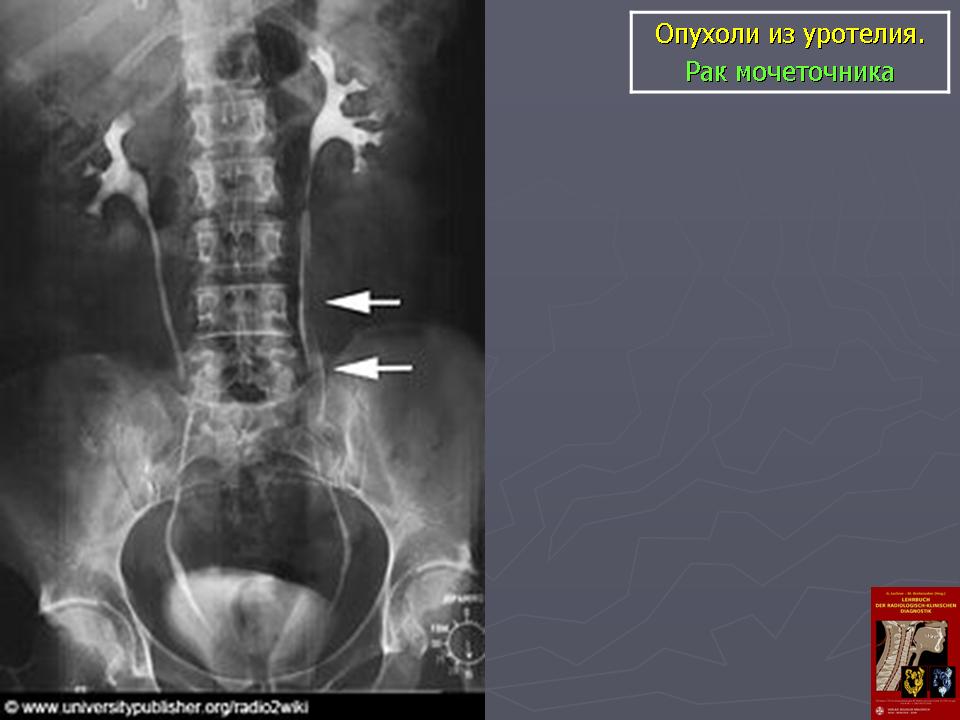 Устье левого мочеточника фото