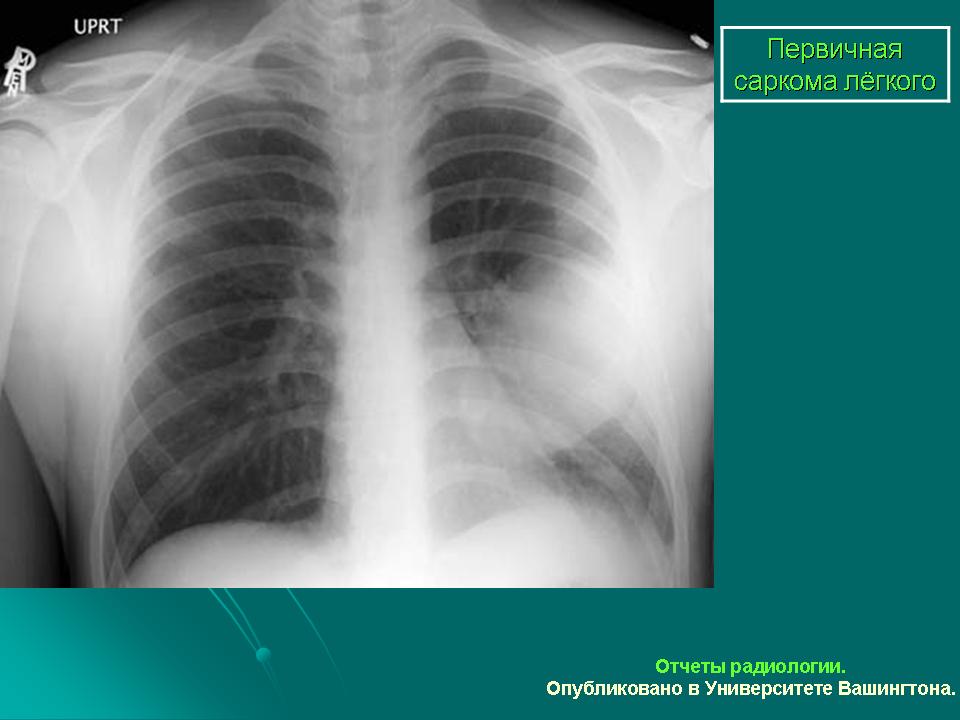Опухоль легких. Саркома легкого рентген. Саркома легкого на рентгенограмме. Саркома лёгких рентген. Доброкачественная опухоль легкого рентген.