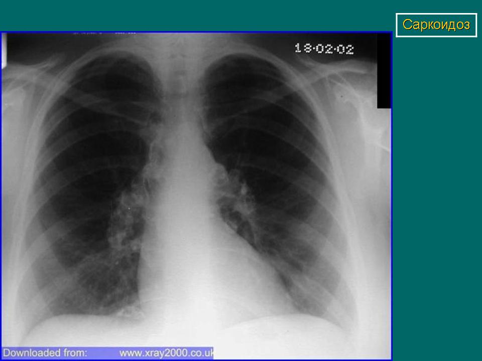 Саркоидоз легких на рентгене фото