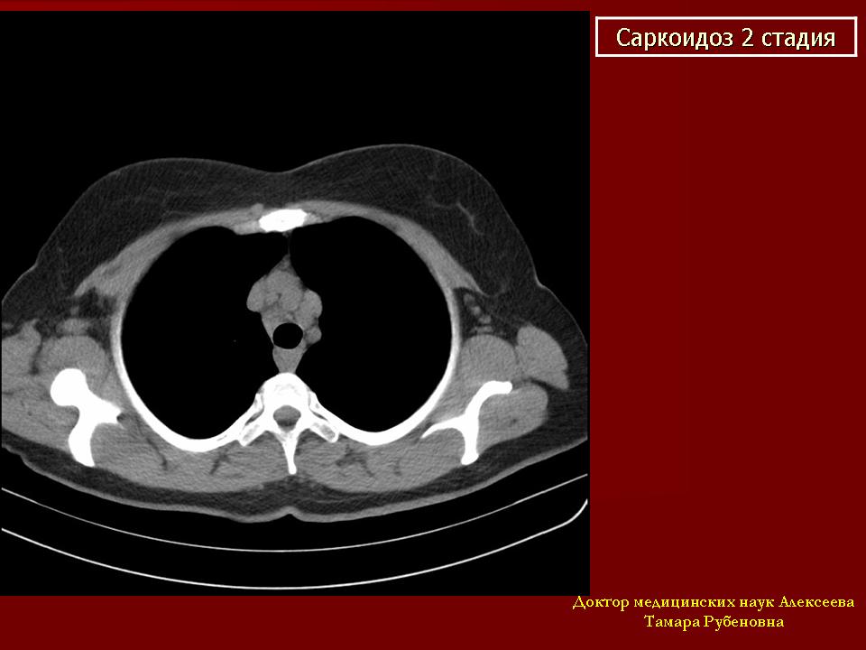Кт картина саркоидоза
