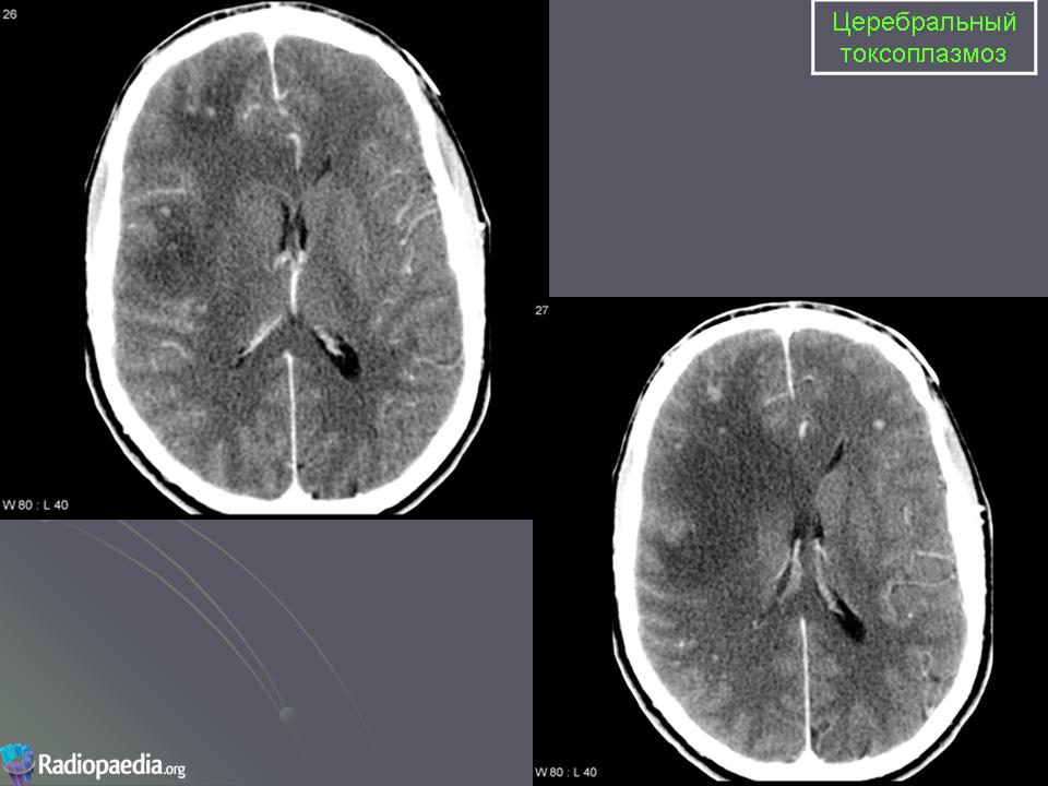 Токсоплазмоз головного мозга кт картина