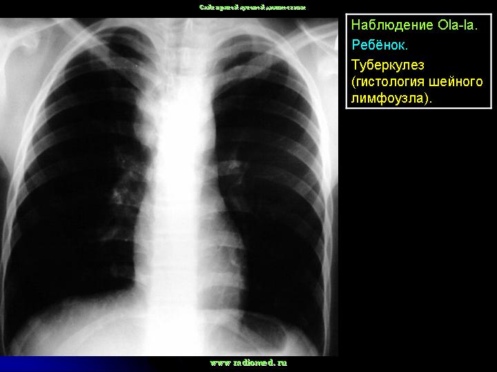 Туберкулез сегодня. Туберкулез внутригрудных лимфатических узлов рентген. Бронхоскопия туберкулез внутригрудных лимфатических узлов. Туберкулез внутригрудных лимфоузлов кт. Туберкулез внутригрудных лимфоузлов рентген.