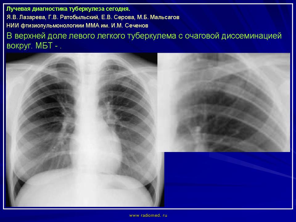 Туберкулез сегодня. Фиброзно очаговый туберкулез рентген. Рентгенодиагностика легких. Рентгенодиагностика туберкулеза. Лучевая диагностика туберкулёза лёгких.