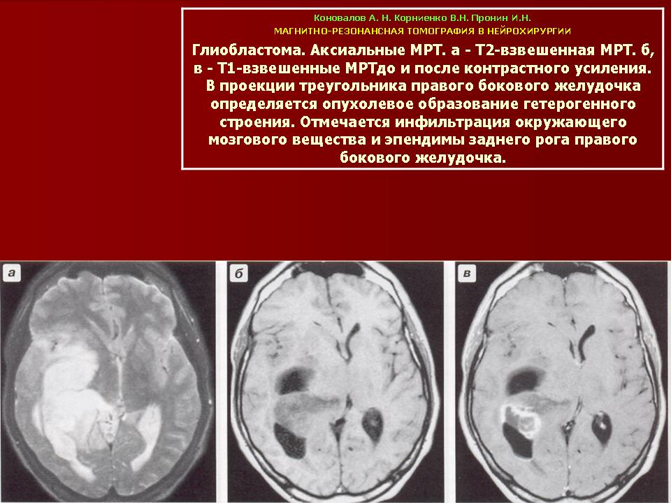 Глиобластома. Глиобластома 4 желудочка. Характеристика глиобластомы.