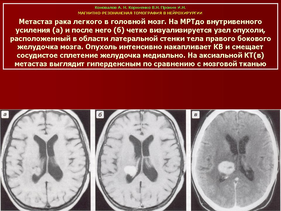 Метастазы в мозгу форум. Метастазы головного мозга кт.