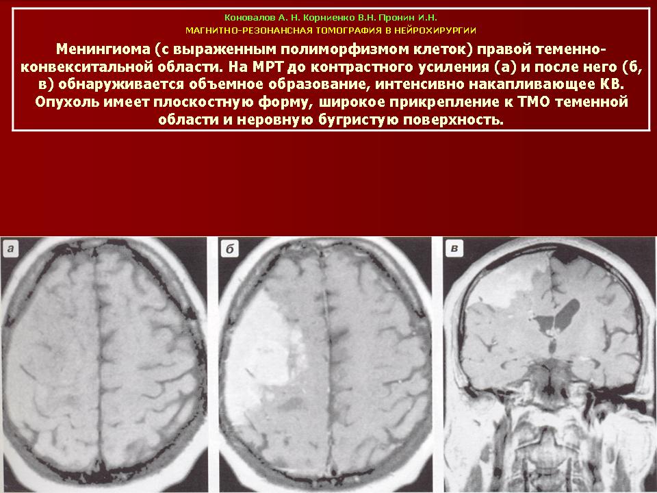 Менингиома головного мозга лечение
