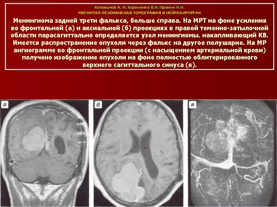 Менингиома головного мозга продолжительность операции. Кальцинированная менингиома лобной доли. Парасагиттальная менингиома лобной доли. Фалькс менингиома кт. Обызвествление менингиомы.