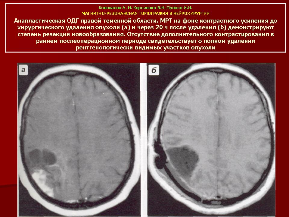 Кистозно глиозные изменения головного мозга что это. Олигодендроглиома головного мозга на кт. Олигодендроглиома мрт. Олигодендроглиома правой височной доли.