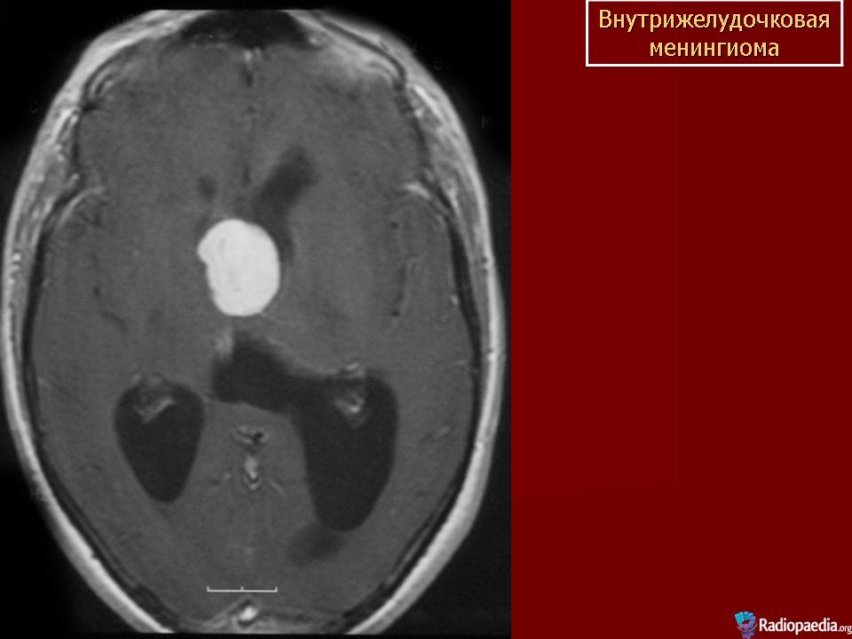 Киста в мозгах последствия. Менингиома 3 желудочка. Порэнцефалическая киста головного мозга. Внутрижелудочковая менингиома мрт.