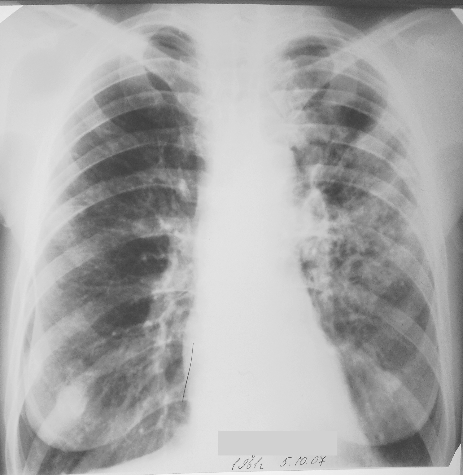 К т легких 10. Рентгенотомография легких. Кт здоровых легких. Чистое легкое к т. Здоровые лёгкие на кт.