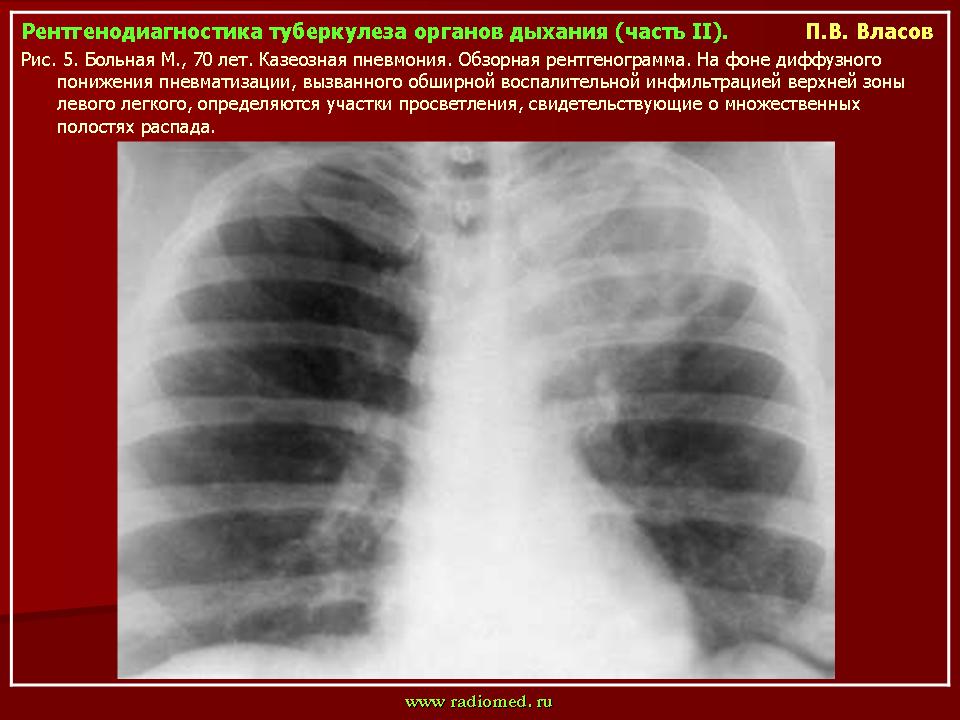 Клинический случай туберкулез