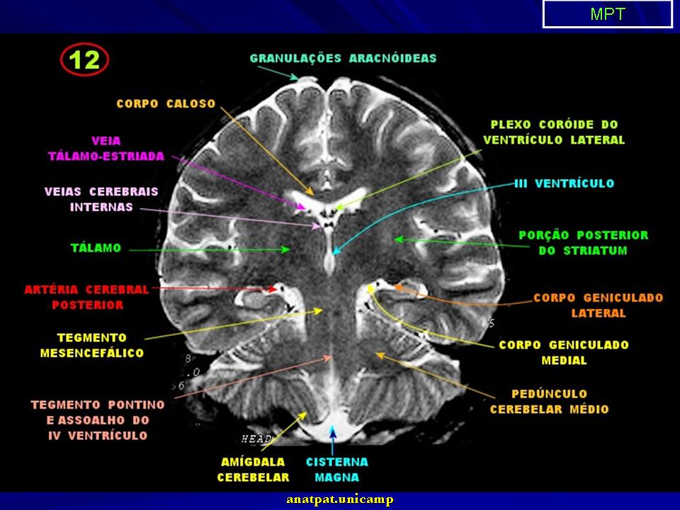 Изменение в базальных отделах. Базальные ядра мозга мрт. Мрт головного мозга аксиальный срез. Средний мозг мрт норма. Анатомия мозолистого тела головного мозга мрт.