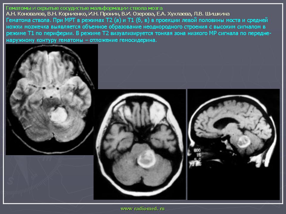 Brain 167. Астроцитома головного мозга в стволе. Гематома ствола мозга кт. Анапластическая астроцитома ствола мозга. Шваноима в головном мозге.