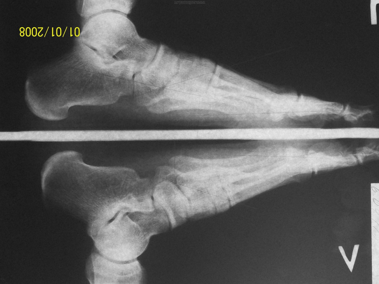 Деформация пальцев стопы мкб. Деформирующий остеоартроз стопы рентген. Артрит голеностопа на рентгене. Деформирующий артроз голеностопа. Деформирующего артроза в суставах среднего отдела стопы.