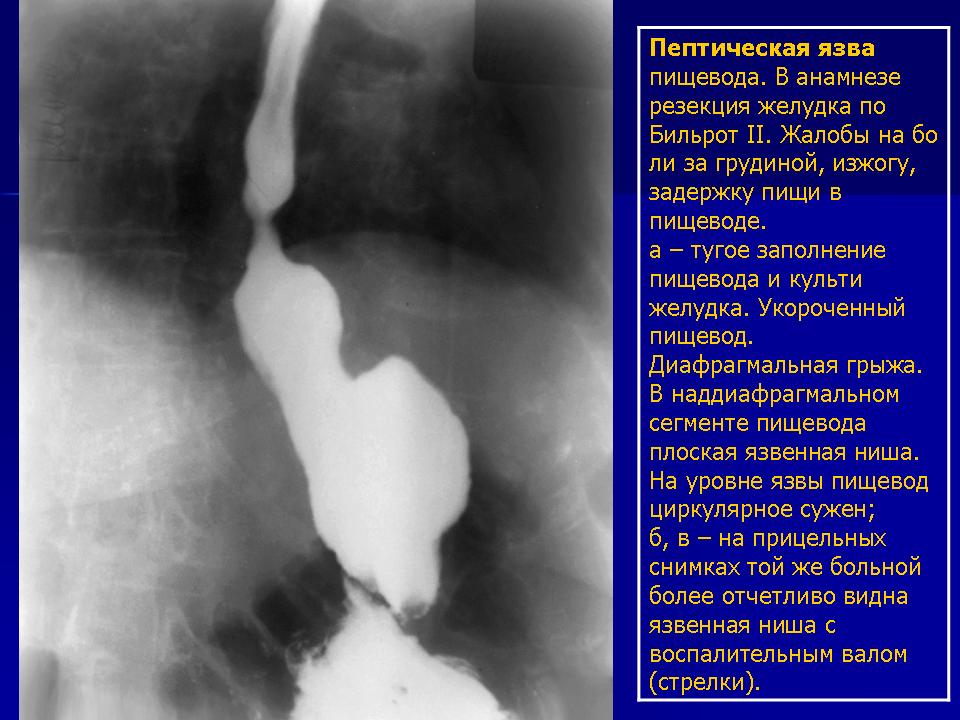 Рецидив пищевода