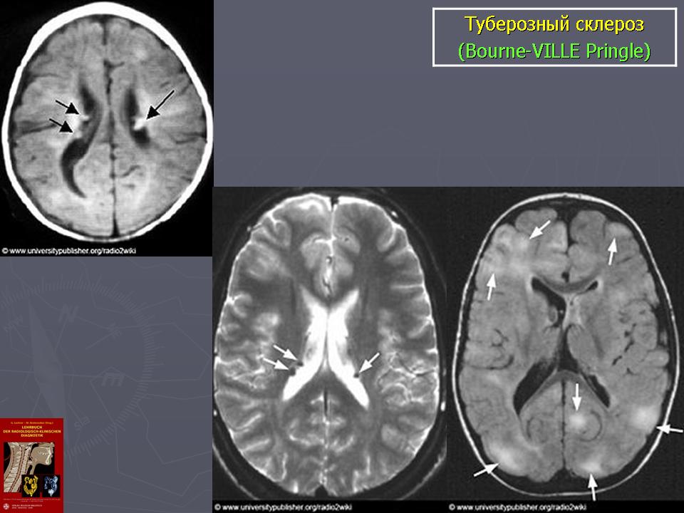 Туберозный склероз. Туберозный склероз Бурневилля. Туберозный склероз бабочка. Туберозный склероз черепа. Туберозный склероз головного мозга у детей.