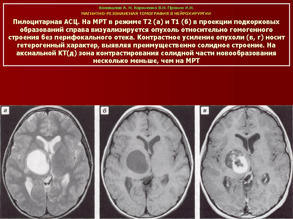 Астроцитома головного мозга прогноз