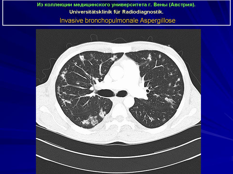 Аспергиллез кт картина