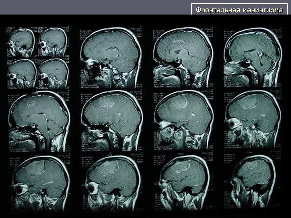 После операции менингиомы головного мозга. Менингиома рентген черепа. Ольфакторная менингиома. Менингиома кости черепа. Менингиома основания черепа.