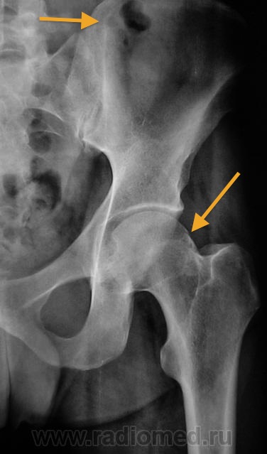 Рентген тазобедренного сустава. Коксартроз 1 степени рентген. Синовит тазобедренного сустава рентген. Коксартроз тазобедренного сустава 1 на рентгене. Коксартроз тазобедренного сустава снимки рентгена.