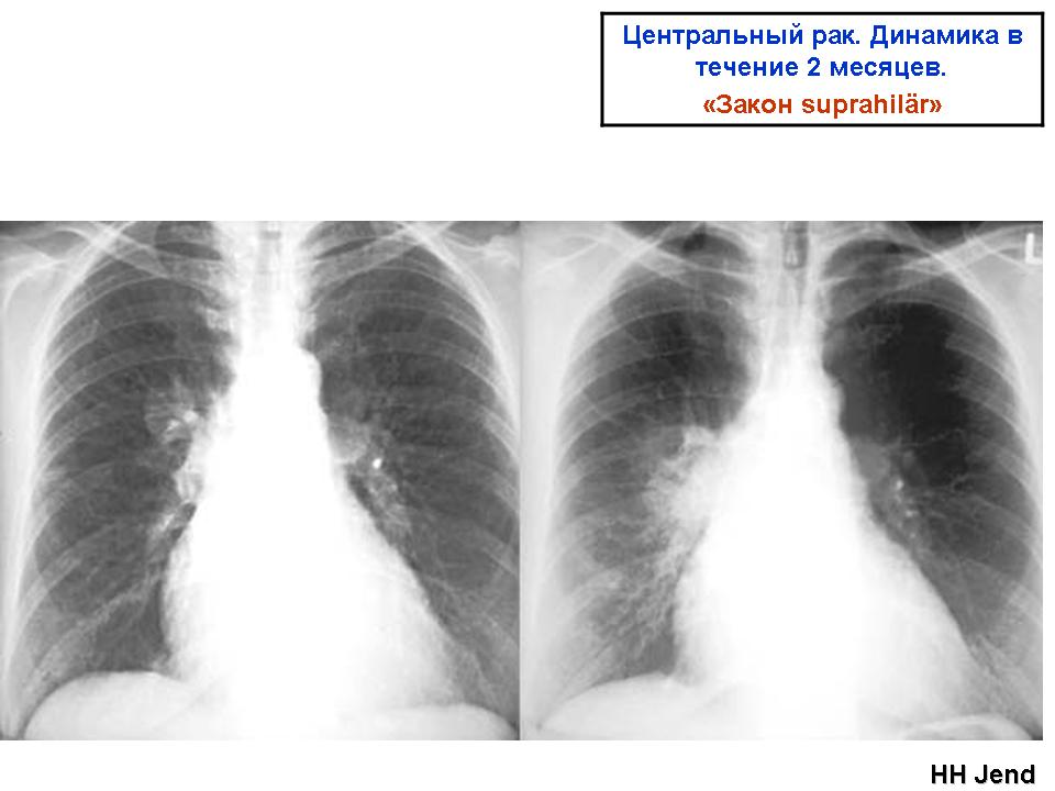 Центральный рак