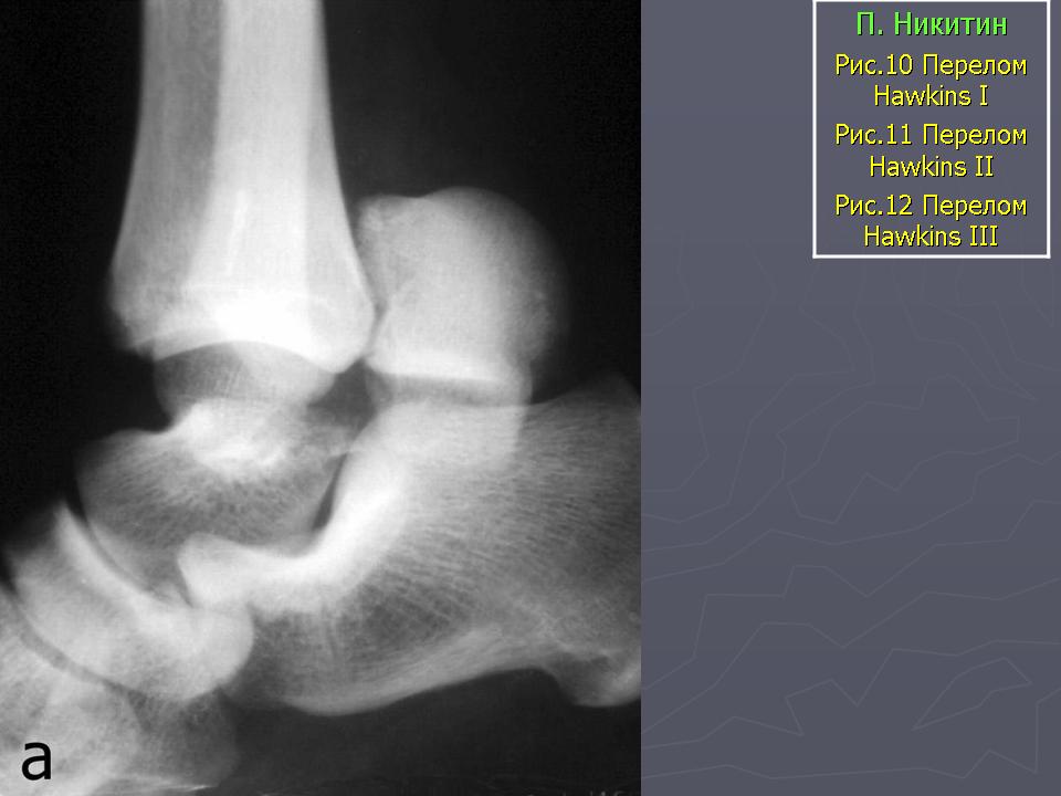 Шпора на рентгене фото. Перелом шейки таранной кости рентген. Перелом таранной кости рентген. Краевой перелом таранной кости рентген. Трабекулярный перелом таранной кости.