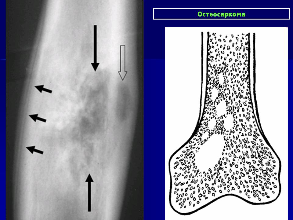 Костные саркомы. Остеогенная остеолитическая саркома. Рентген трубчатых костей. Саркома голени рентген.