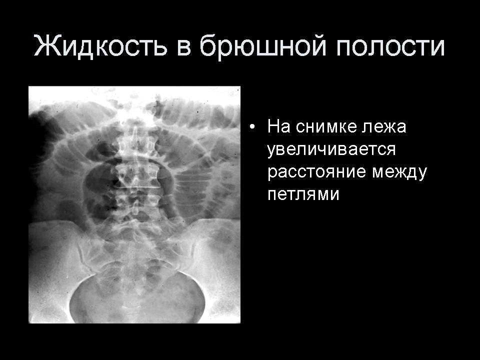 Полость страдать. Обзорный рентген брюшной полости норма. Асцит рентген брюшной полости. Рентген брюшной полости патологии. Обзорная рентгенография органов брюшной полости.