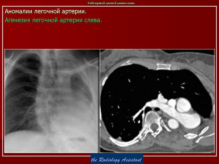 Вид легочной артерии. Агенезия легочной артерии рентген. Гипоплазия легочной артерии рентген. Аномалии развития легочных артерий. Агенезия пупочной артерии это.