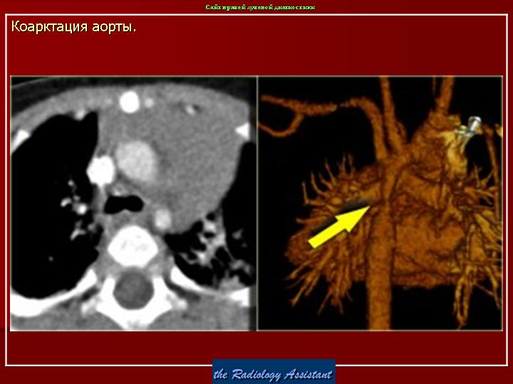 Коарктация аорты фото
