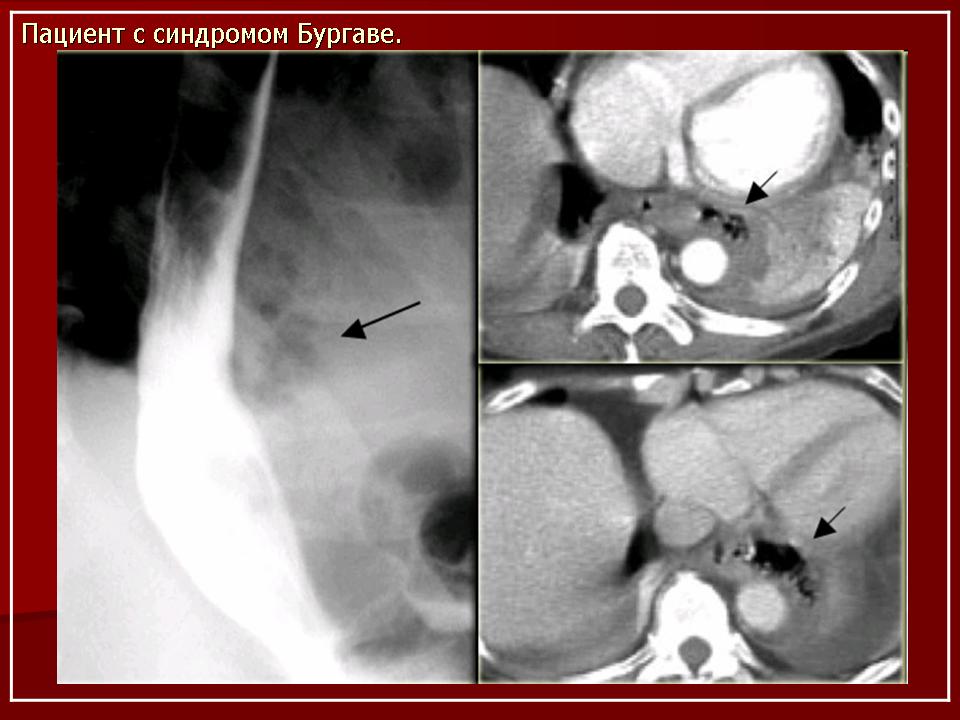 Разрыв пищевода причины. Перфорация пищевода медиастинит. Кт разрыв пищевода медиастинит. Перфорация пищевода при бужировании.