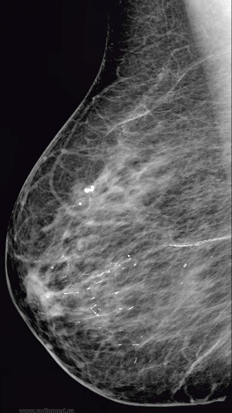 Аденоз на маммографии. Мелкоузелковый аденоз. Склерозирующий аденоз. Склерозирующий аденоз маммография.