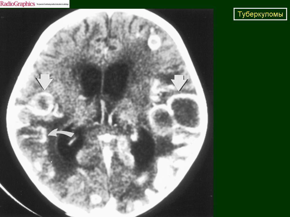 Туберкулезный менингит. Туберкулезный менингит кт. Туберкулезный менингоэнцефалит кт.