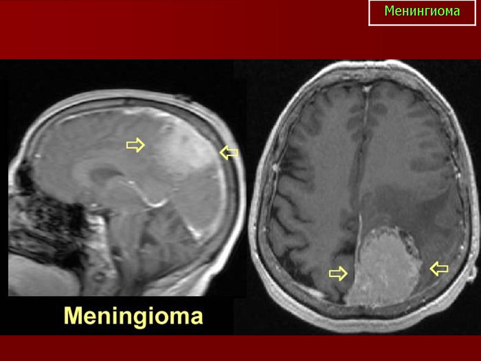 После операции менингиомы головного мозга. Менингиома лобной доли кт. Менингиома теменной кости на кт. Менингиома височной доли. Супратенториальная менингиома.