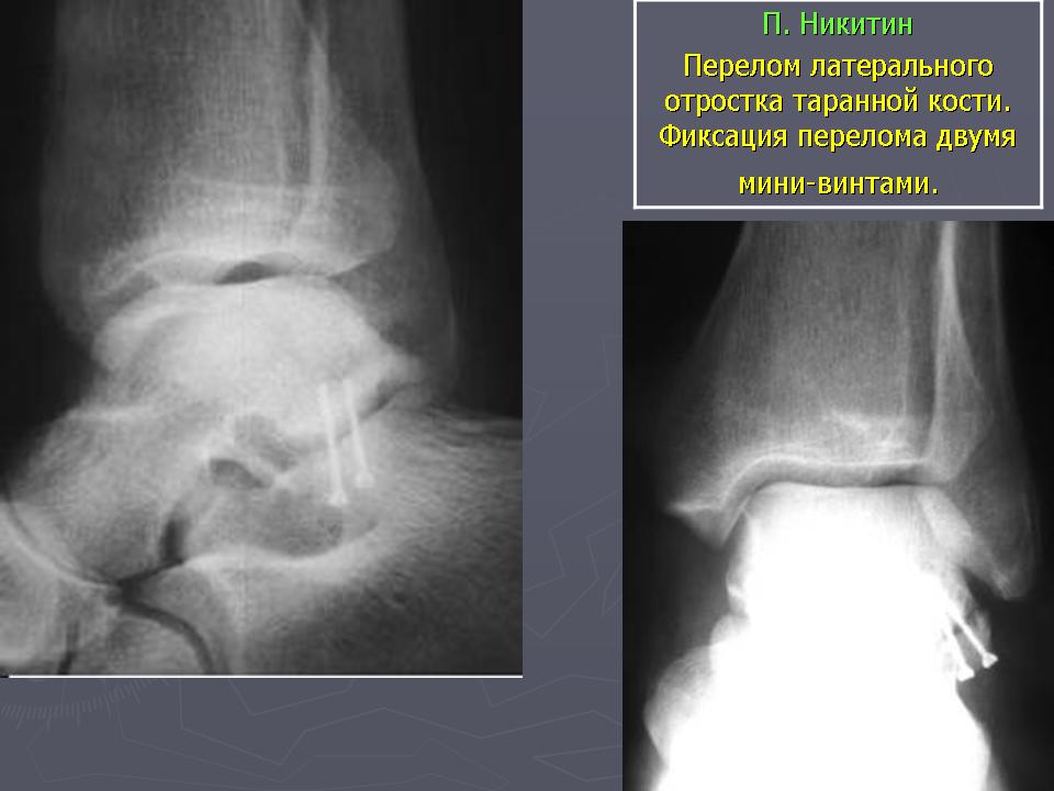 Задний край без смещения. Перелом заднего отростка таранной кости. Краевой перелом заднего отростка таранной кости. Перелом заднего отростка таранной кости рентген. Перелом шейки таранной кости рентген.