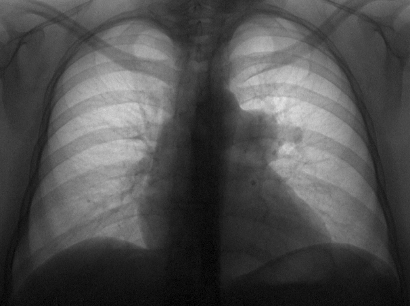Рентген легких норма и патология фото