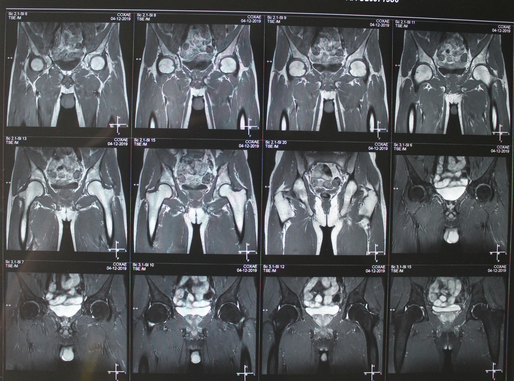 Что покажет мрт тазобедренного сустава у женщин. Деформирующий остеоартроз тазобедренных суставов мрт. Коксартроз тазобедренного сустава мрт. Мрт тазобедренного сустава норма. Мрт тазобедренных суставов Пертеса.