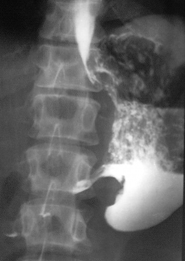 Грыжа пищевода рентген. Рентгеноскопия желудка грыжа. Скирр желудка на рентгенограмме.