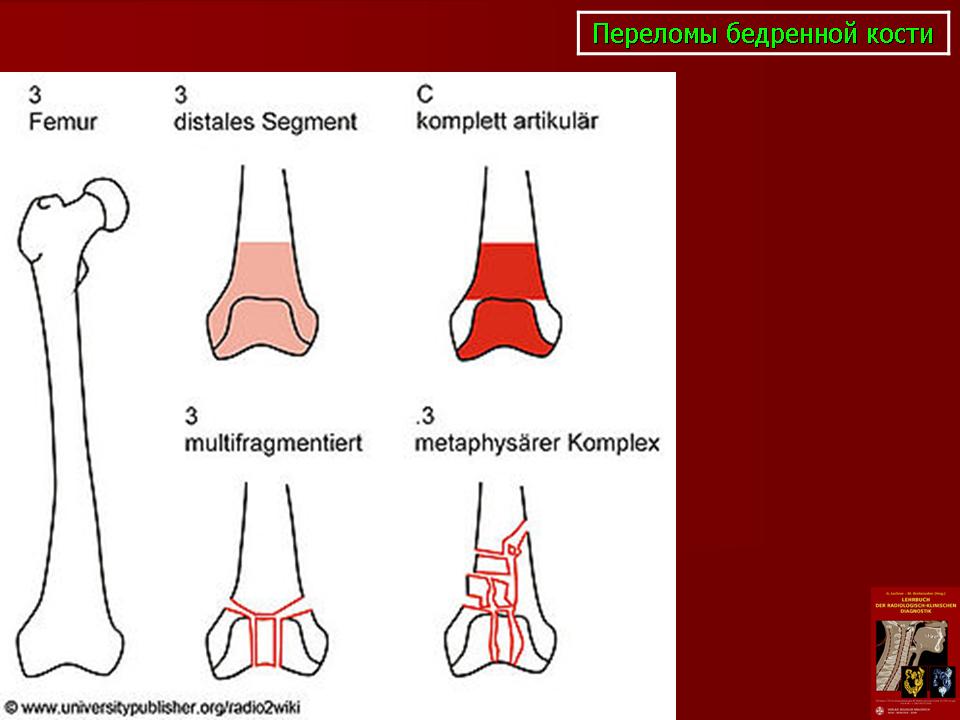 Через бедренный перелом. Краевой перелом бедренной кости. Открытый перелом бедренной кости. Виды переломов бедра. Перелом бедренной кости рентген.