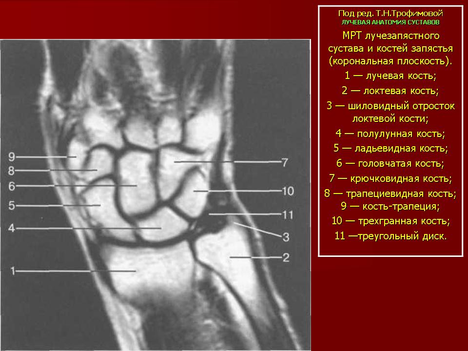 Треугольный мениск лучезапястного сустава фото