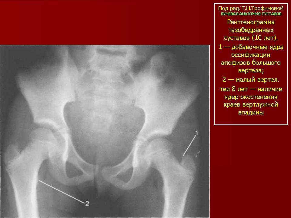 Окостенение головки бедренной кости. ТБС рентген анатомия. Ядра окостенения тазобедренных суставов рентген. Кости таза анатомия рентген. Анатомия подвздошной кости рентген.