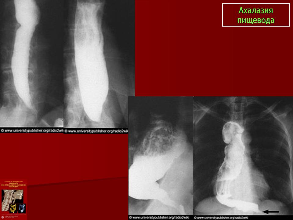 Ахалазия пищевода рентген фото