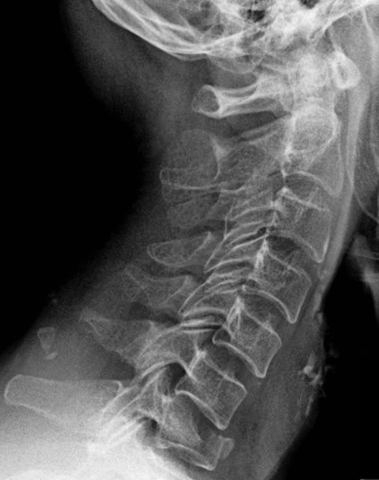 Перелом поясницы. Переломы позвонков рентген. Компрессионный перелом позвоночника рентген. Компрессионный перелом грудного отдела позвоночника рентген. Компрессионно-оскольчатый перелом позвонка рентген.