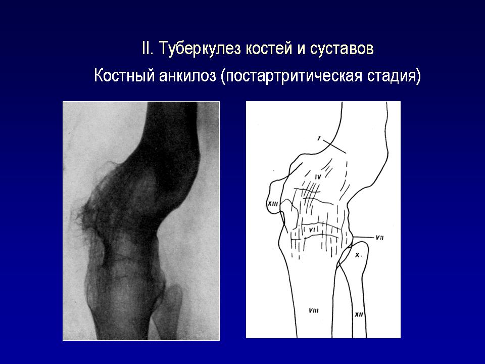 Туберкулез ноги. Туберкулез костей постартритическая фаза. Костно-суставной туберкулез стадии. Туберкулёз кости рентгенодиагностика. Постартритическая фаза туберкулеза рентген.