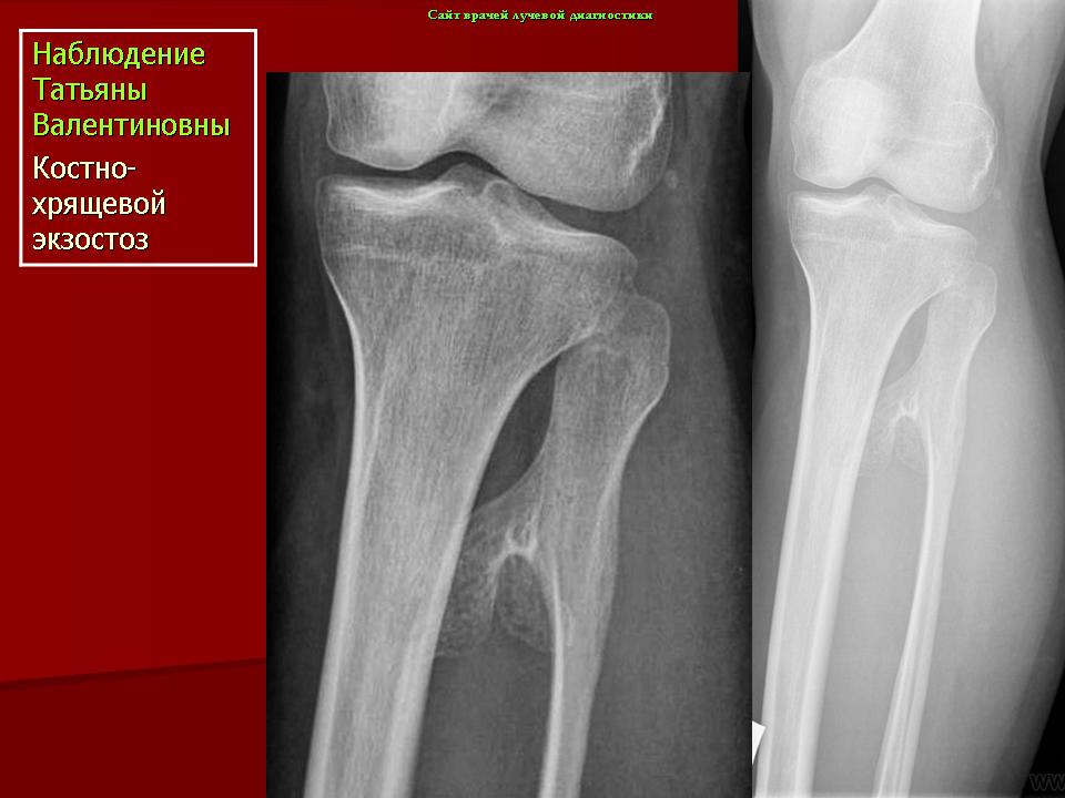 Экзостоз что. Костно-хрящевой экзостоз. Костно-хрящевой экзостоз рентген. Экзостоз большеберцовой кости рентген.