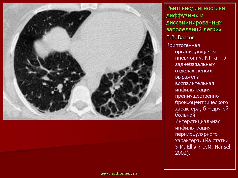 Диффузная легких. Криптогенная организующаяся пневмония на кт. Диссеминированный пневмония на кт легких. Диссеминированное поражение легких кт. Криптогенная пневмония кт.