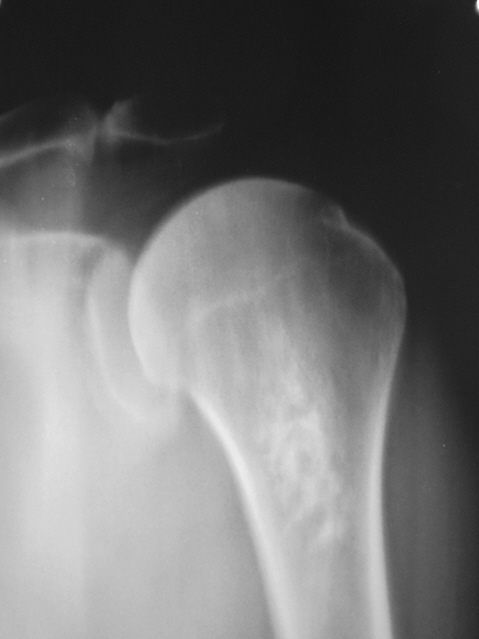 Рентген плеча здорового человека фото