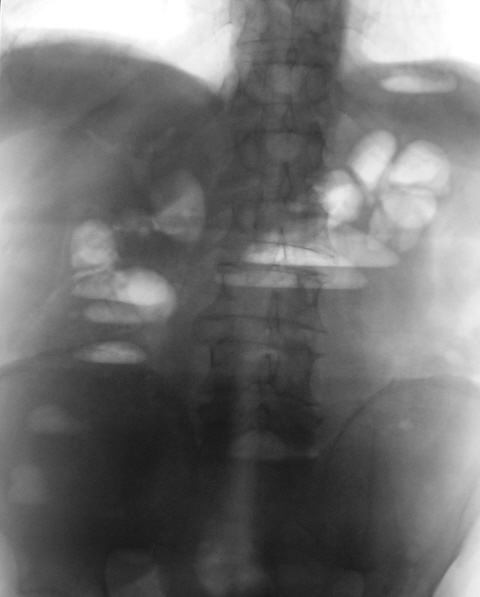 Рентген брюшной полости